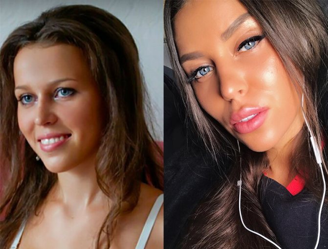 Таня Строкова до и после пластических операций.